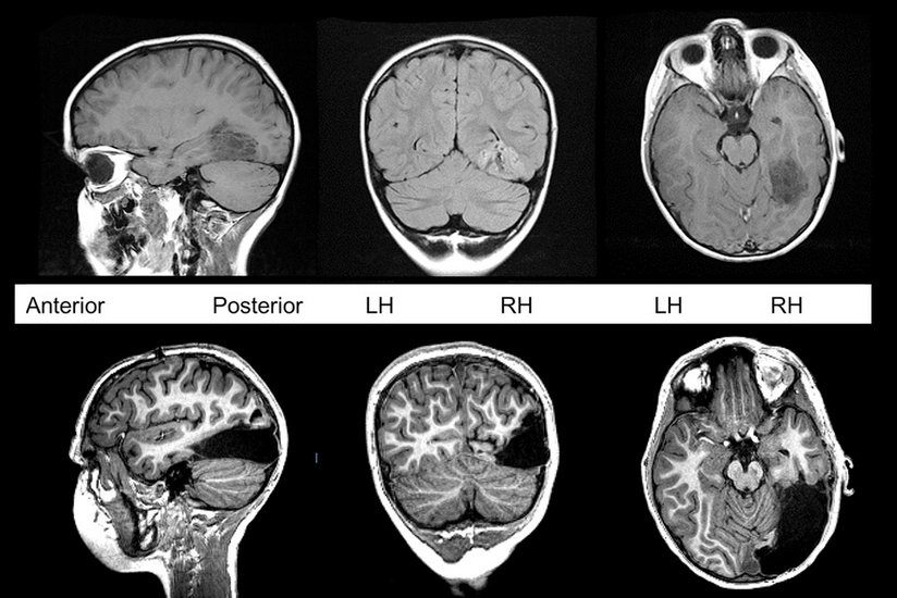 Koronavirusun insan beynindəki fəsadları aşkarlanıb