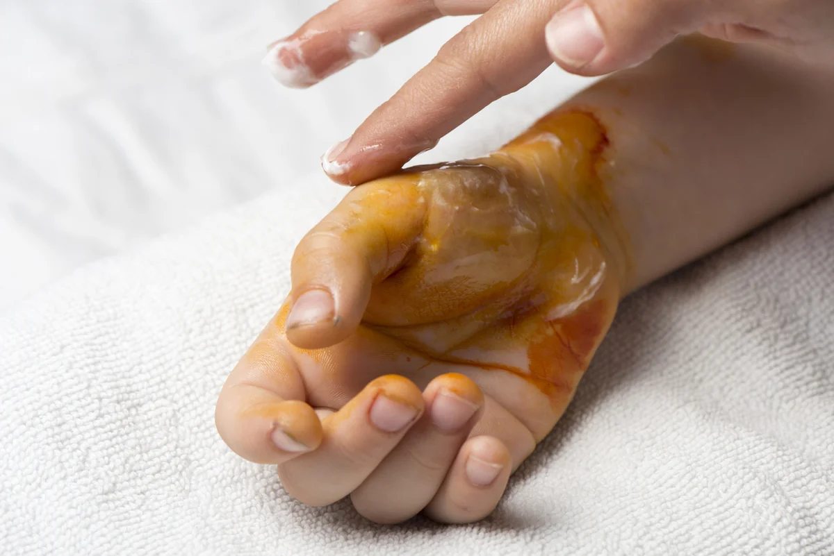 Sabirabadda 6 yaşlı uşaq yanıq xəsarətləri aldı