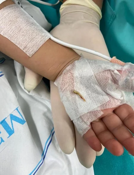 Bakıda 2 yaşlı körpə bir il nəfəs borusunda sümük parçası ilə yaşayıb