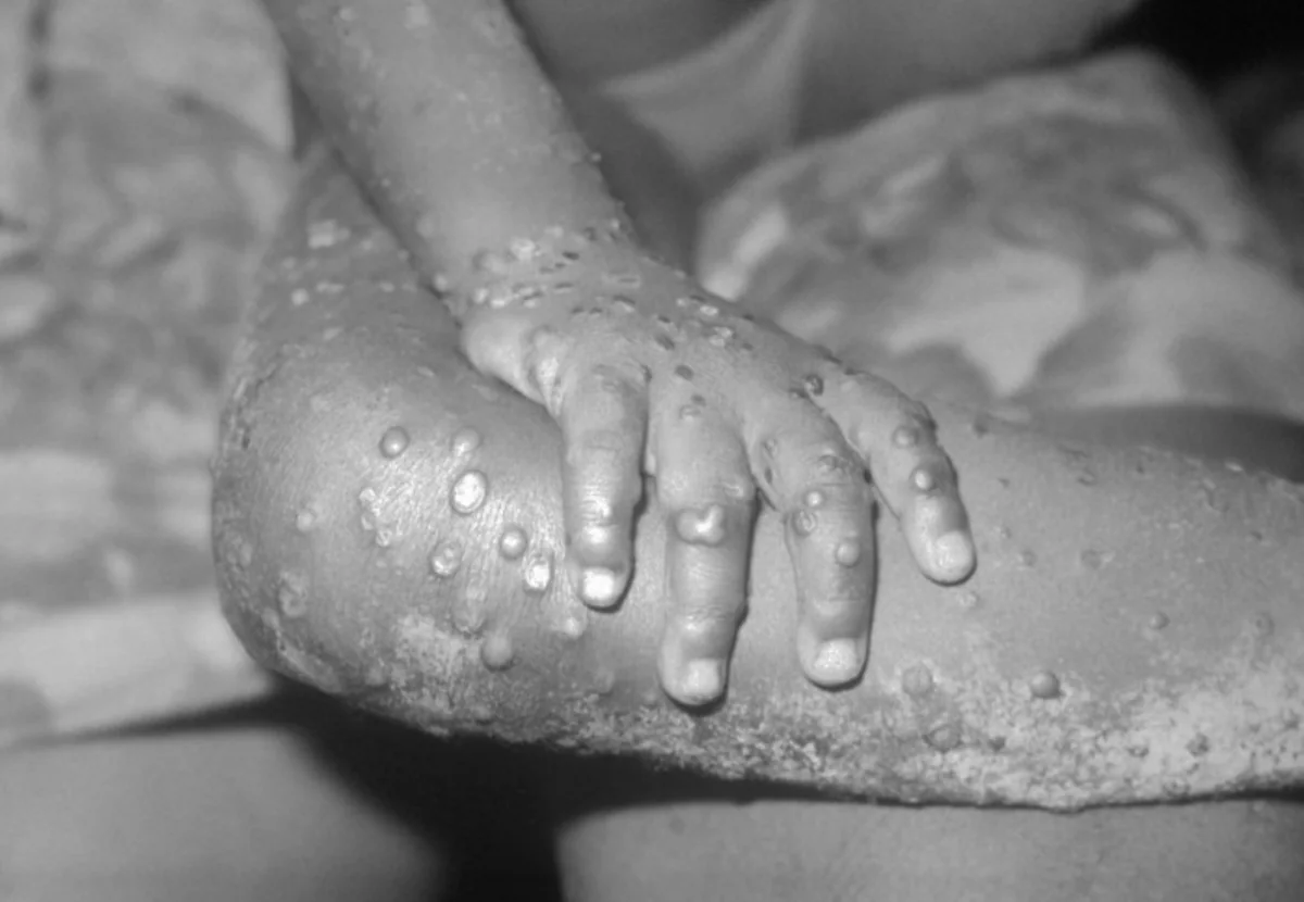 UK confirms seven new cases of monkeypox