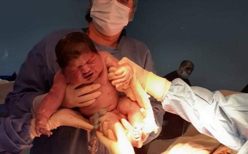 Gürcüstanda 5 kiloqramdan artıq çəkidə körpə doğulub