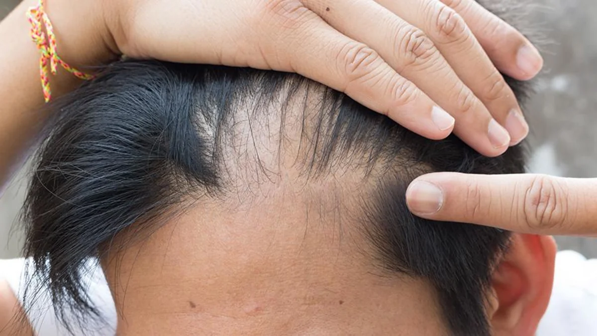 Japan scientists develop new method of combating baldness