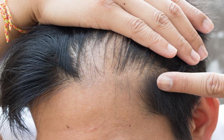 Japan scientists develop new method of combating baldness
