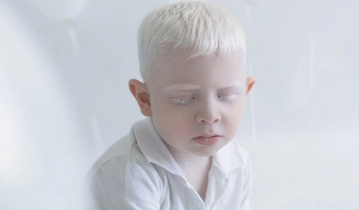 Nazirlik: “Azərbaycanda albinos insanların statistikası aparılmır”