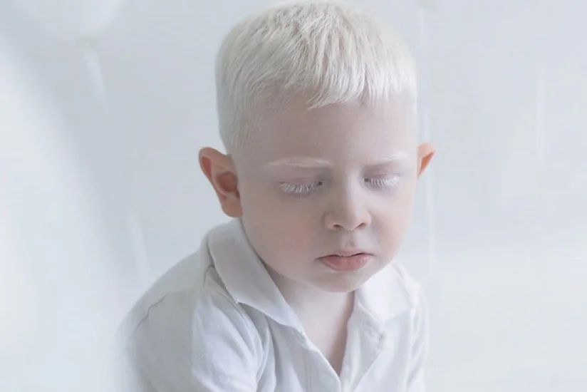 Nazirlik: “Azərbaycanda albinos insanların statistikası aparılmır”