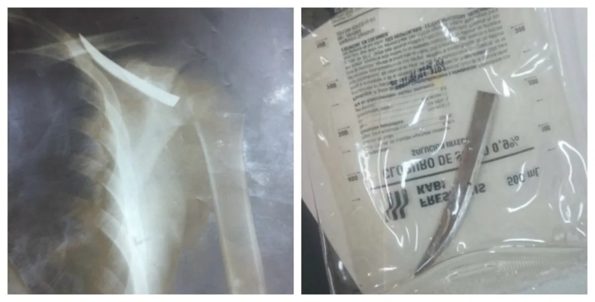 ​Colombian man lived with a knife in his back for a month