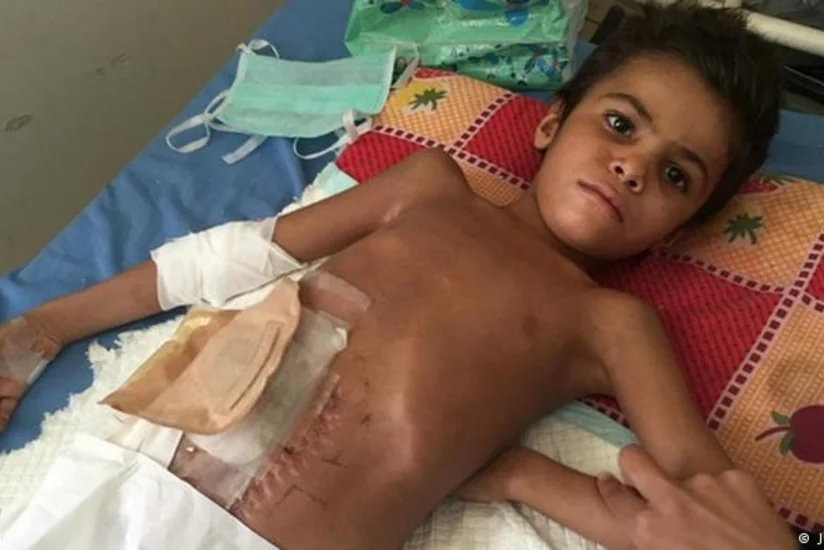 ООН: В 2016 году в ходе вооруженных конфликтов в мире убиты или искалечены более 8 тыс. детей