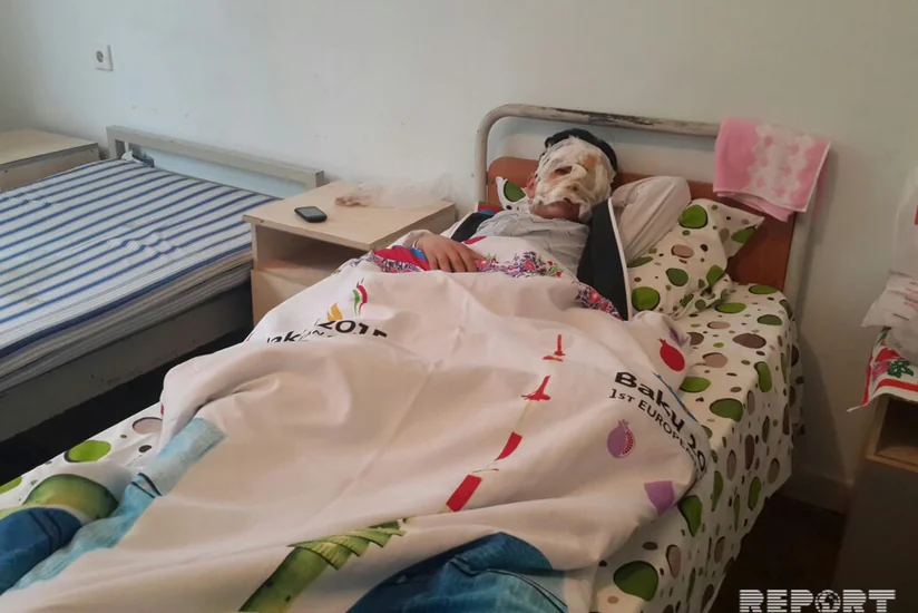 Od çərşənbəsində ocaq qalayan məktəblinin üzü yanıb - FOTO