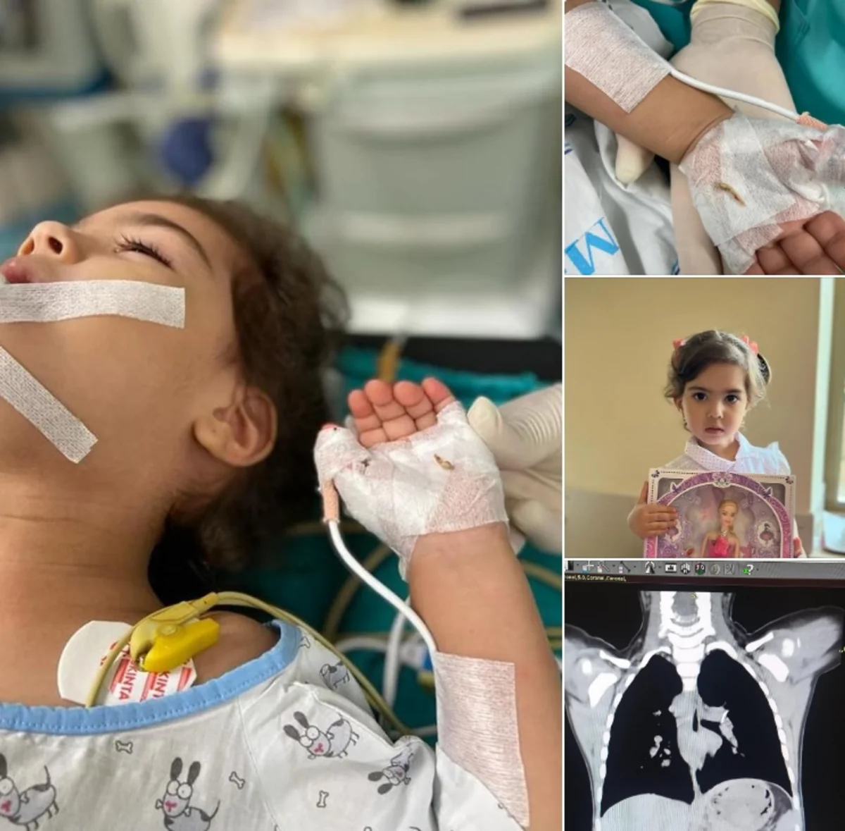 Bakıda 2 yaşlı körpə bir il nəfəs borusunda sümük parçası ilə yaşayıb