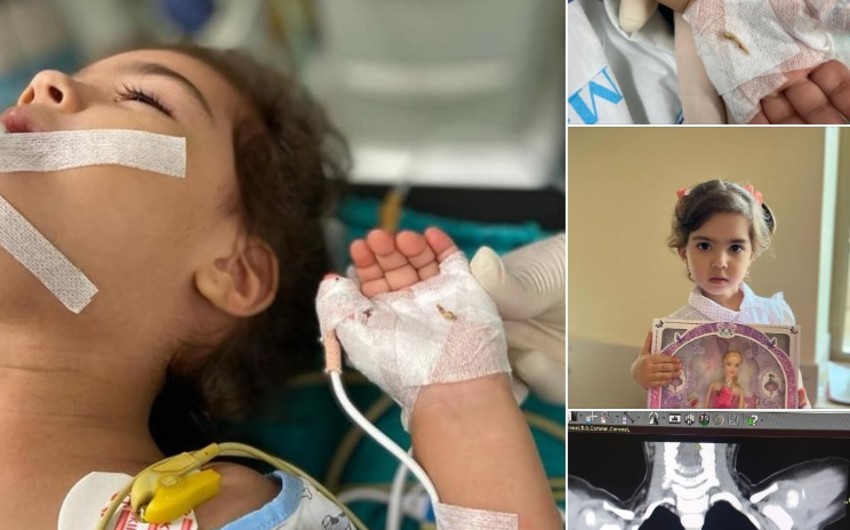 Bakıda 2 yaşlı körpə bir il nəfəs borusunda sümük parçası ilə yaşayıb