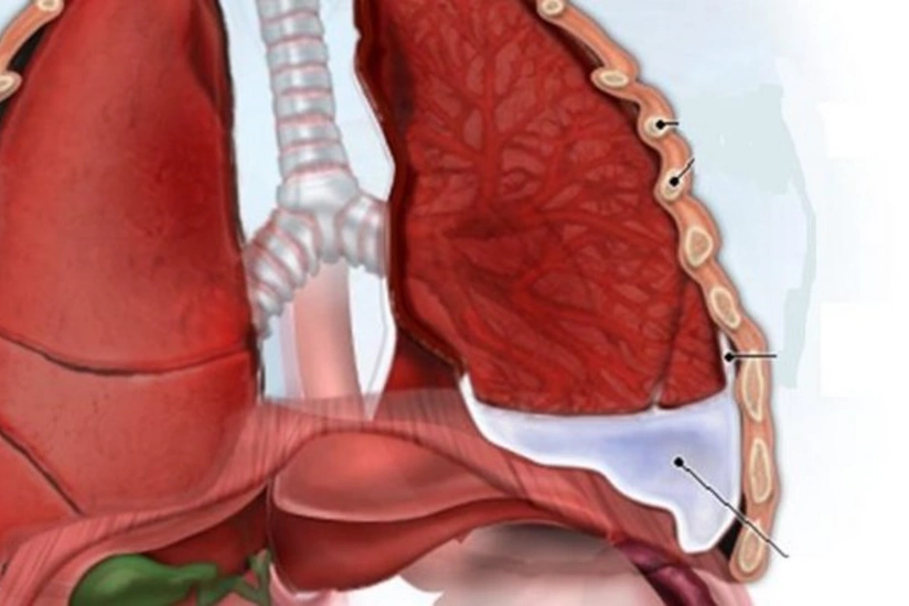 Səhiyyə Nazirliyinin eksperti: Plevrit xəstəliyi yalnız təsadüfi müayinə zamanı aşkar edilir