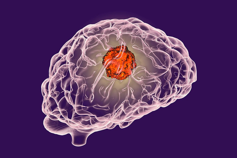 Ученые нашли лекарство от рака мозга