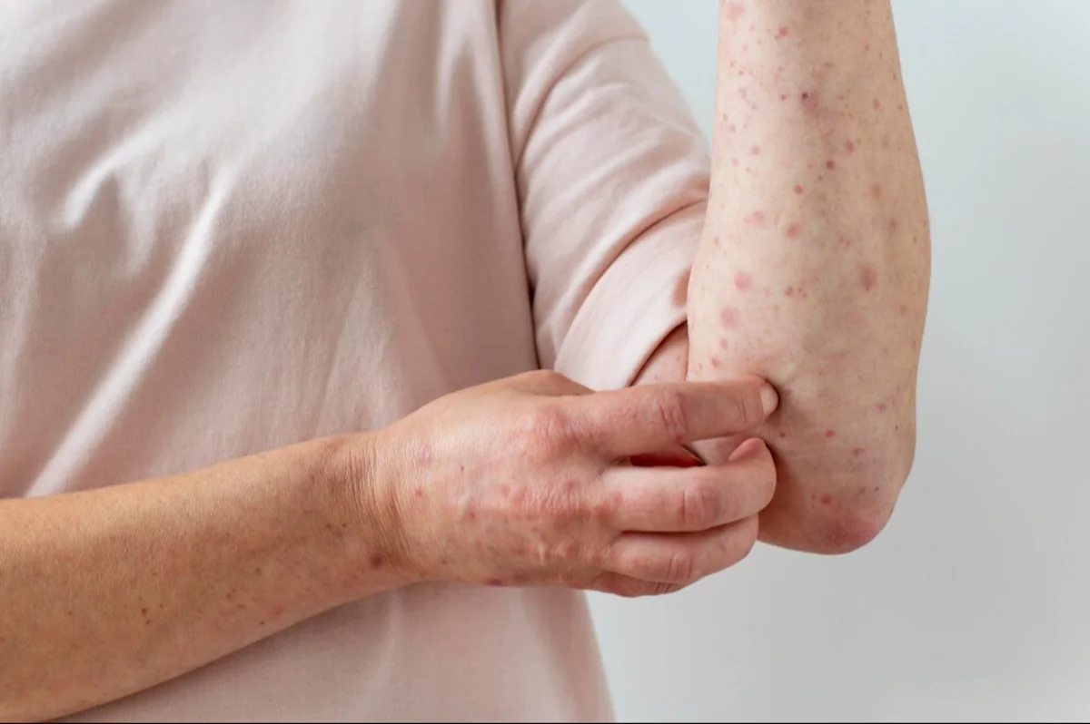 Situation with measles remains alarming in Armenia, health ministry says