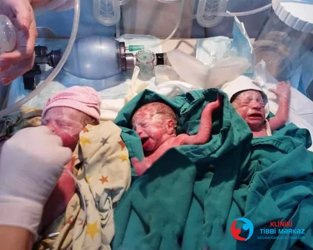 Bakıda COVID-19-a yoluxan hamilələrdən biri üçəm, digəri dördəm dünyaya gətirib