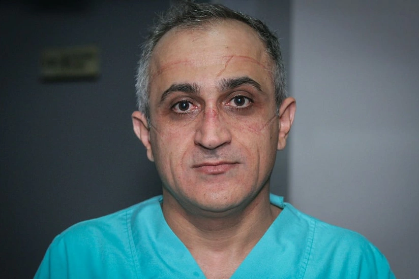 Azərbaycanlı həkim: Koronaviruslu xəstələrin 97%-də simptomlar 11-12-ci günlərdə üzə çıxır