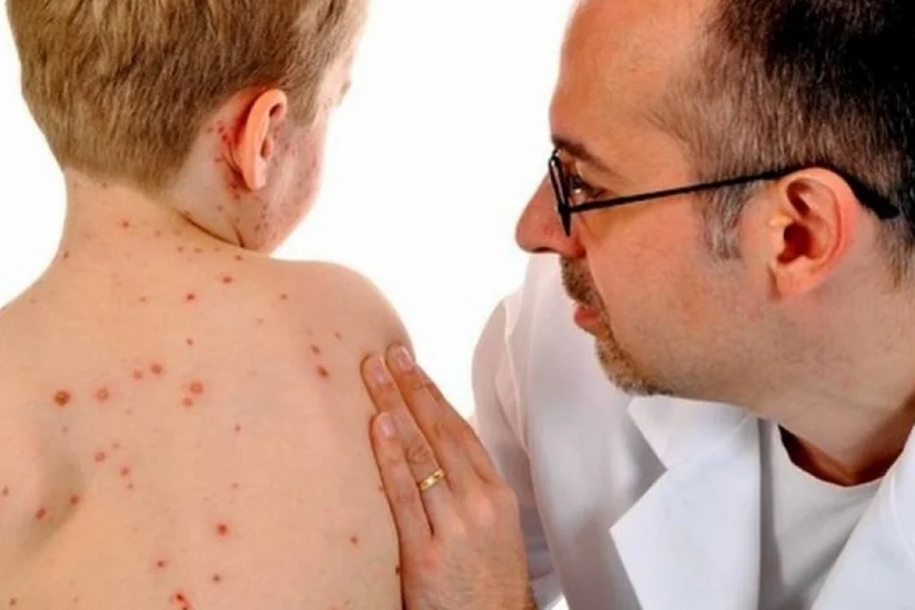 Число зараженных корью в Армении увеличилось до 46