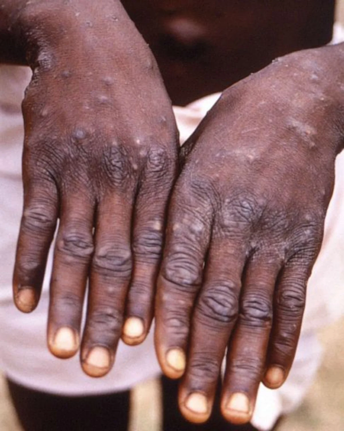 Sri Lanka records first monkeypox case