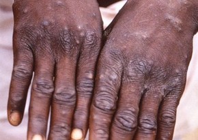 В Шри-Ланке зарегистрировали первый случай оспы обезьян