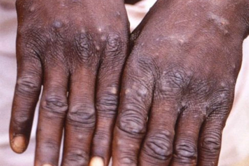 Sri Lanka records first monkeypox case