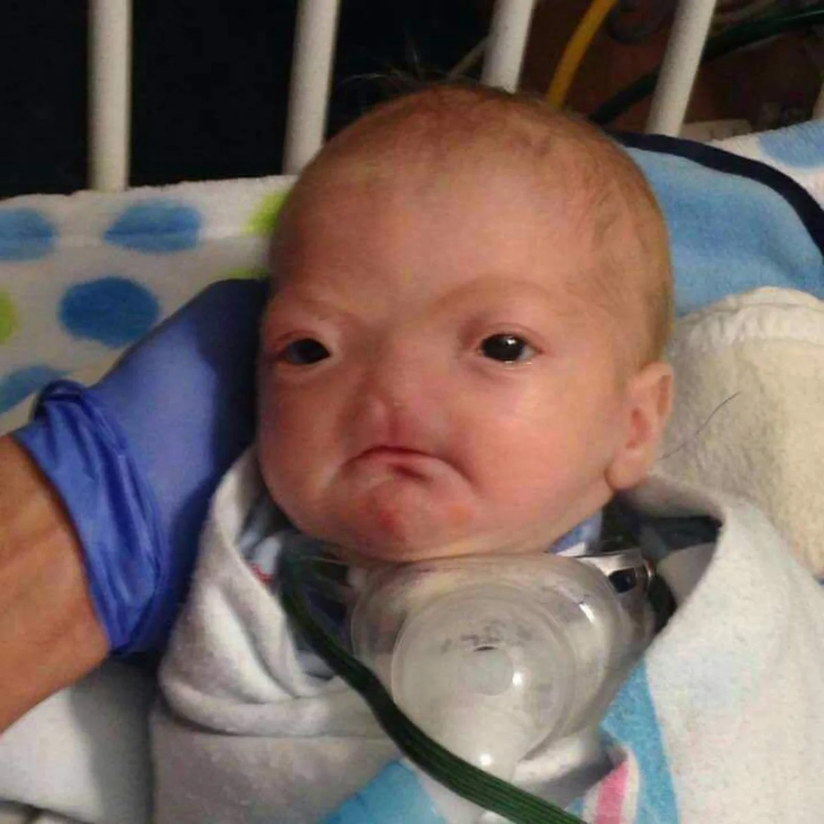 ​В США родился безносый младенец - ФОТО