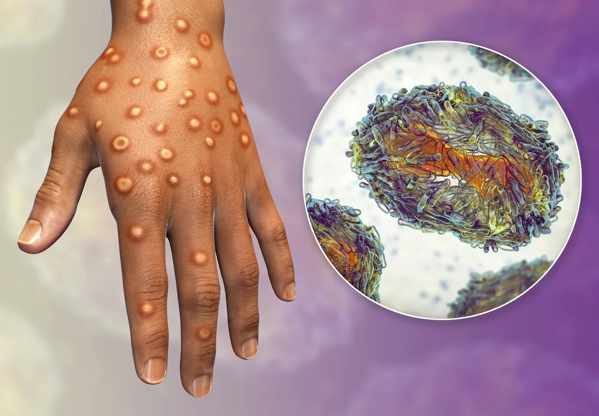 No monkeypox cases recorded in Azerbaijan