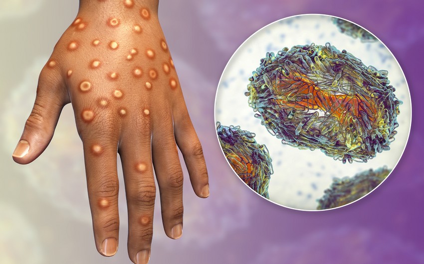No monkeypox cases recorded in Azerbaijan
