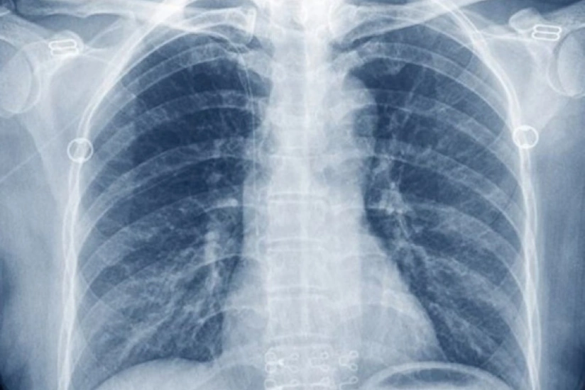 Раскрыт неожиданный признак рака легких