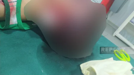 Masazırda azyaşlı uşaqlar itlərin hücumuna məruz qalıblar, vəziyyətləri ağırdır