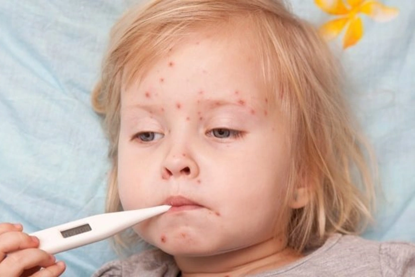 Həkim qızılca ilə bağlı valideynlərə çağırış edib: Uşaqlar tez bir zamanda vaksinasiya olunmalıdır