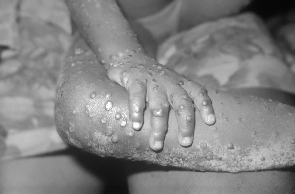 Belgium reports second case of monkeypox in humans