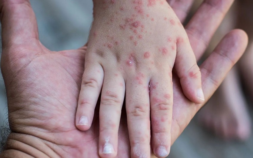 Azerbaijan posts sharp decline in number of measles cases - Official