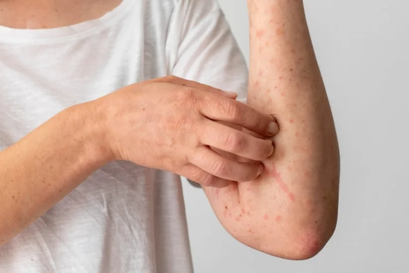 Rumıniyada qızılca epidemiyasının yayıldığı təsdiqlənib
