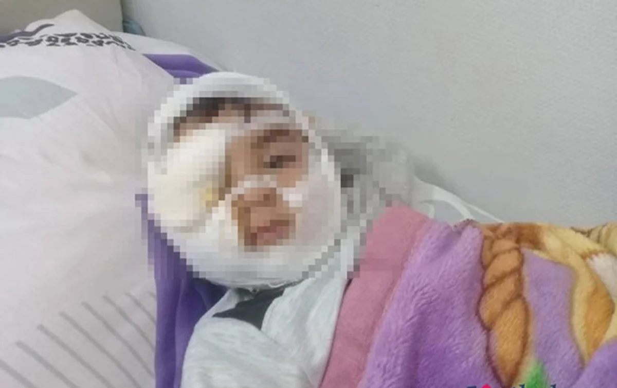 Həkim: İt dişləyən uşağın yaraları kifayət qədər dərin və böyük idi