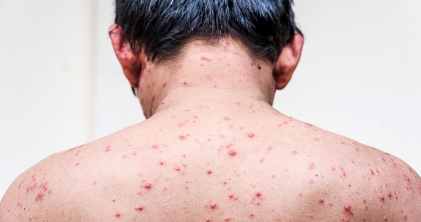 Official: Chickenpox cases are on rise in Azerbaijan