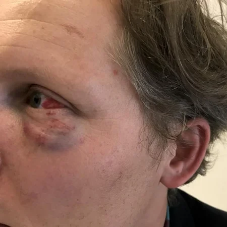 В Германии сторонники РПК избили немецкого журналиста, пытаясь его убить