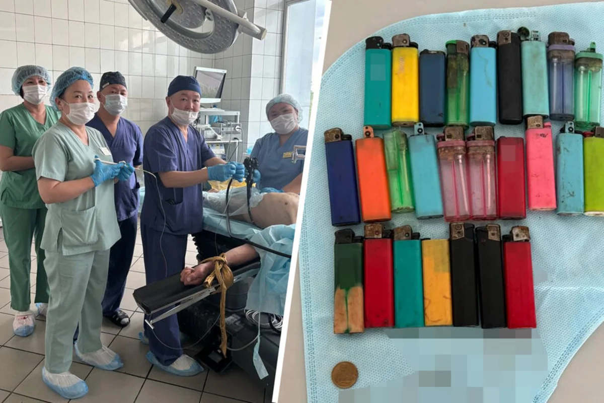 Rusiyada həkimlər 27 alışqan udan kişini xilas edib