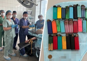 Rusiyada həkimlər 27 alışqan udan kişini xilas edib