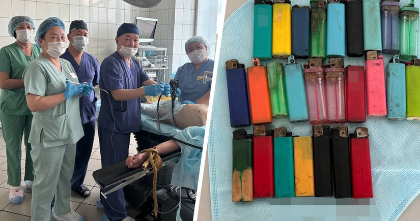 Rusiyada həkimlər 27 alışqan udan kişini xilas edib