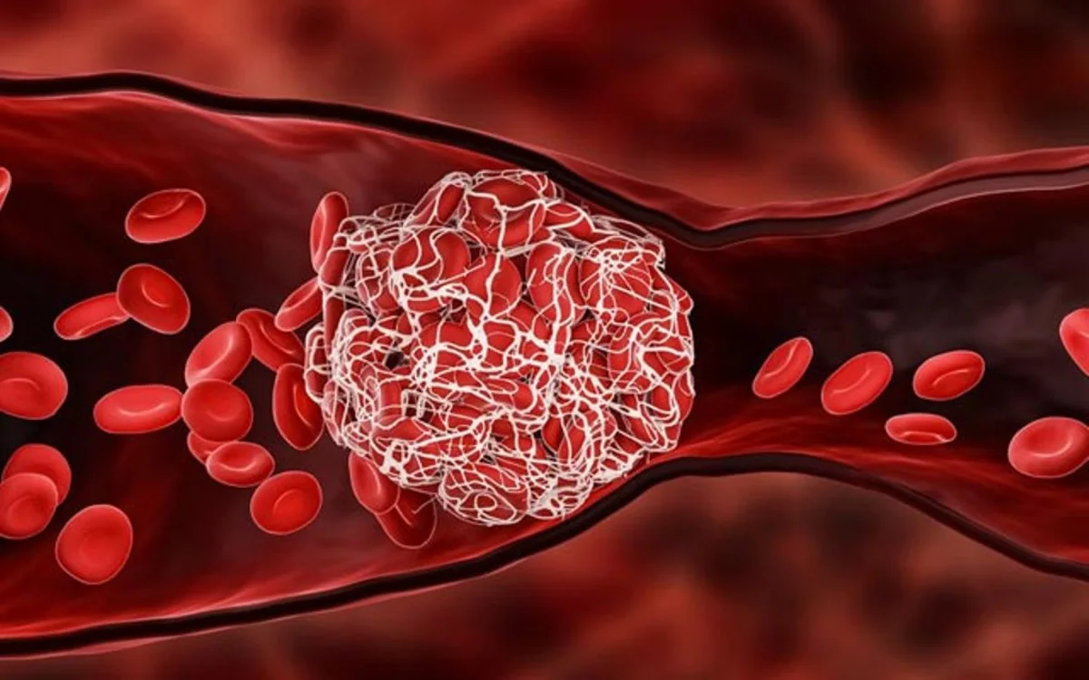 Hematoloq: Qan durulaşdıran dərmanların nəzarətsiz qəbulu hemofiliyalı xəstələr üçün təhlükəlidir