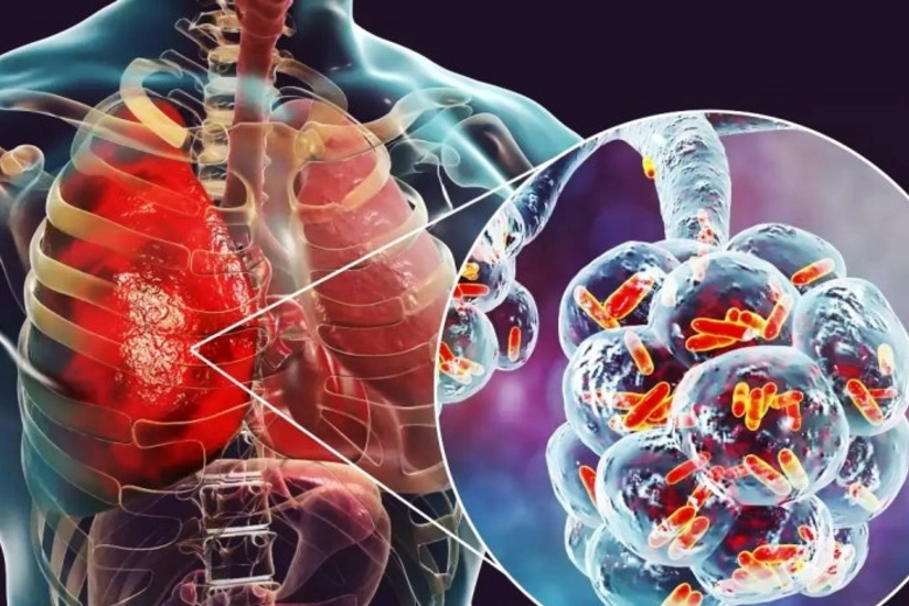 В Азербайджане за год от пневмонии скончались 425 человек