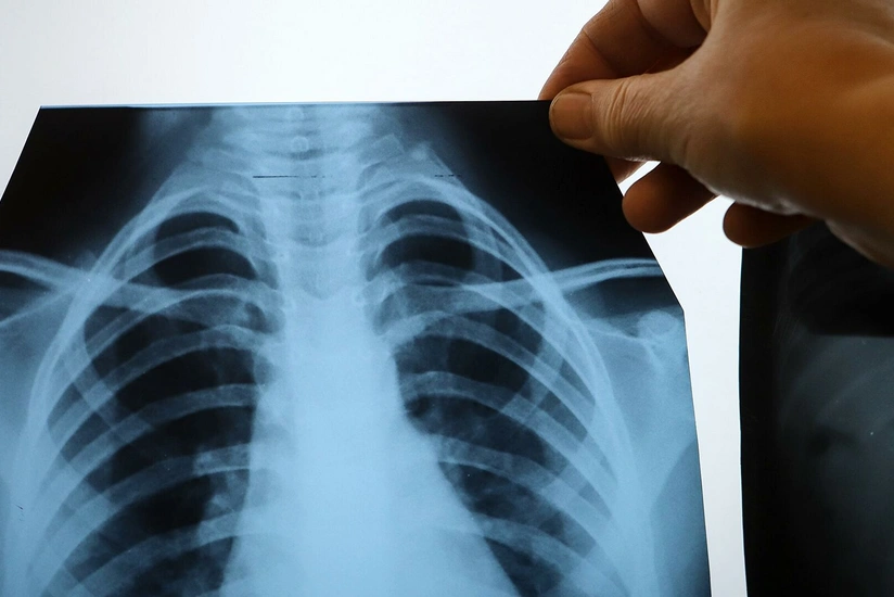 9 symptoms of lung cancer