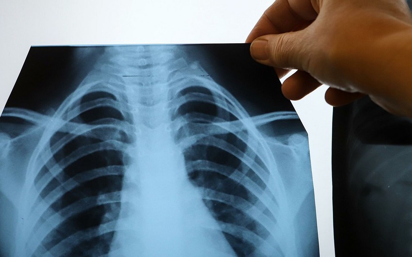 9 symptoms of lung cancer