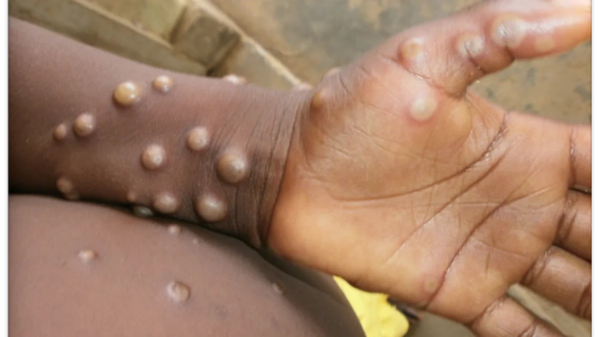 8 countries in Europe report cases of monkeypox