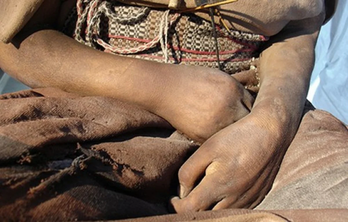 ​92 yaşlı qadın bətnində 50 il ölü döl gəzdirib