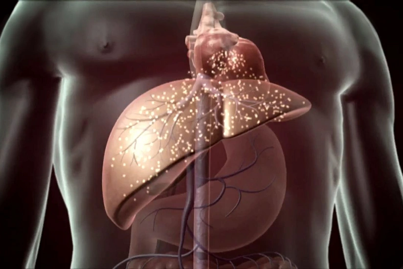 Unusual symptoms of liver cirrhosis named