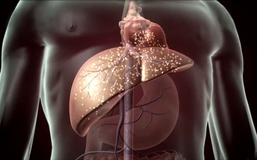 Unusual symptoms of liver cirrhosis named