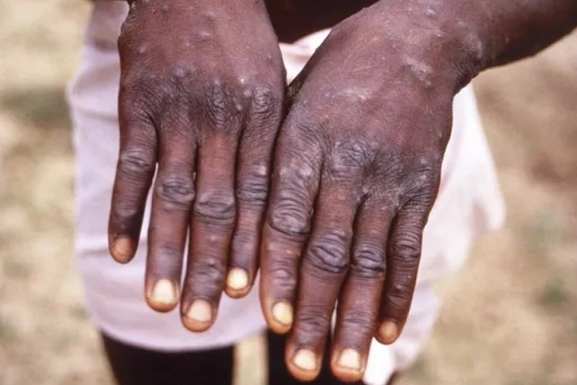 ВОЗ заявила о рекордном уровне заболеваемости mpox за 22 месяца