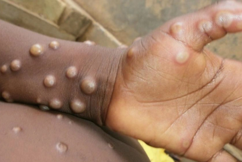 В Конго объявили эпидемию оспы обезьян