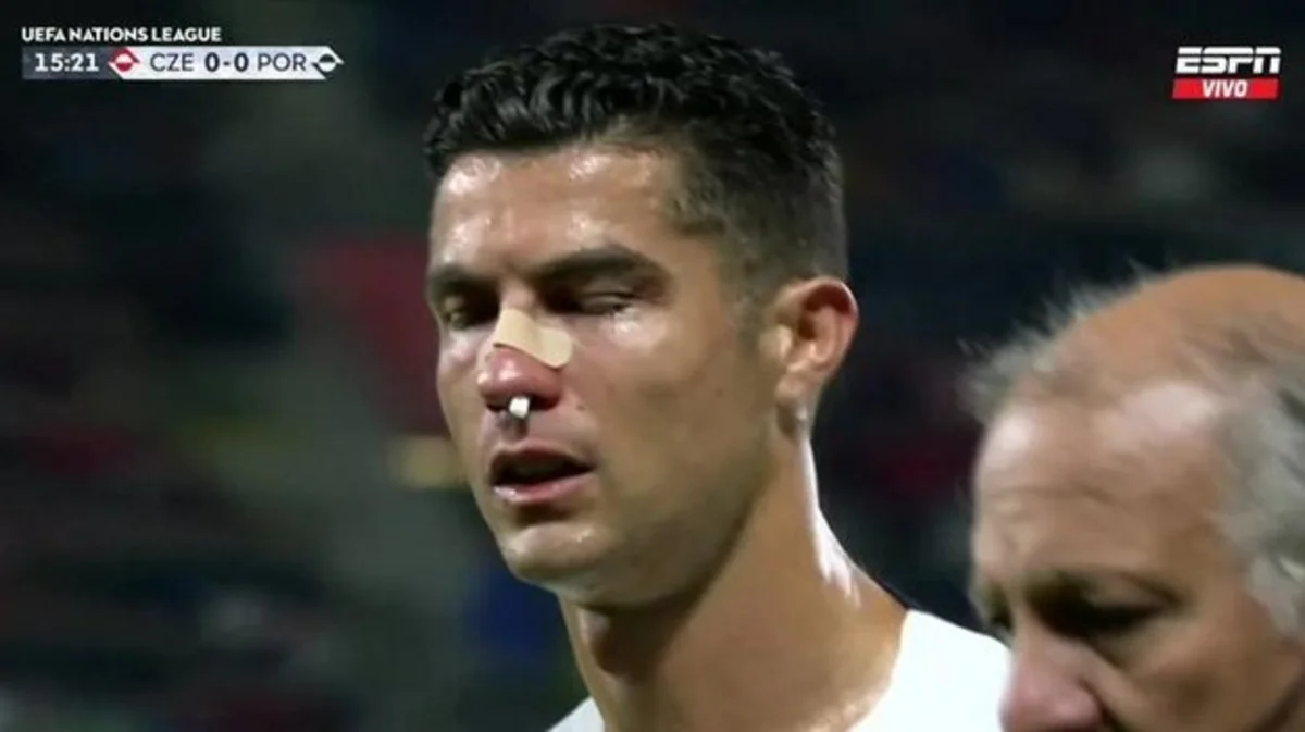 Ronaldu rəqib qapıçı ilə toqquşmadan sonra ciddi xəsarət alıb