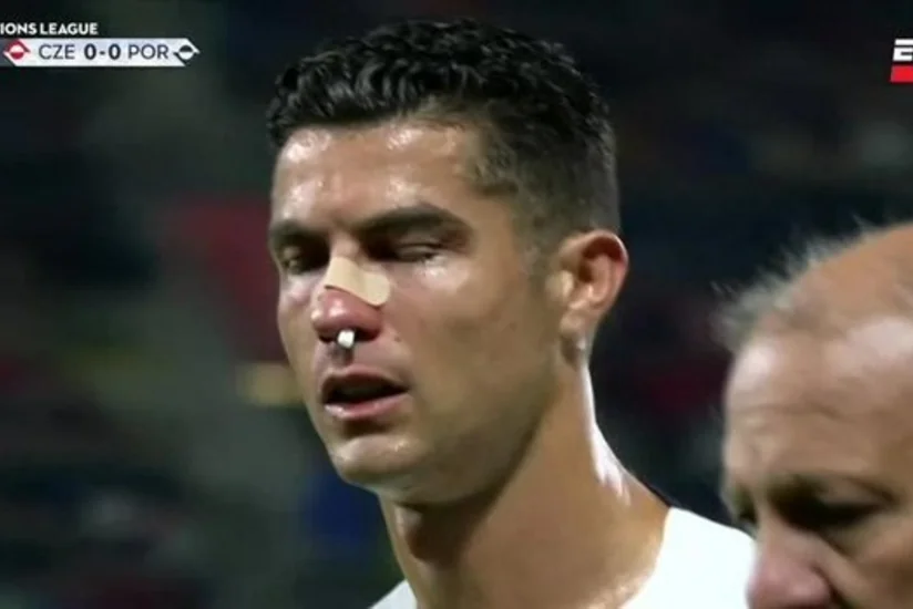 Ronaldu rəqib qapıçı ilə toqquşmadan sonra ciddi xəsarət alıb